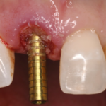 A New Method for Soft Tissue Restoration in the Aesthetic Zone: Dermal Apron Technique with a Clinical Case Example