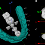 Identified genes determining the shape of teeth: another Neanderthal legacy