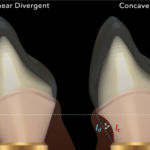 What abutment morphology is better for a gingival connection: linear divergent or concave? Randomized controlled trial of CAD/CAM abutments