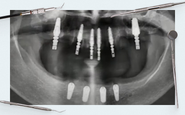 Complex Implantation Cases: A Surgical Guide to Minimally Invasive Approaches – Part 1