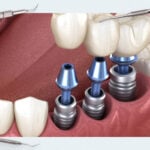 Errors and Complications During Prosthetics on Implants. How to Prevent and Correct Them