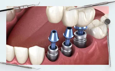 Errors and Complications During Prosthetics on Implants. How to Prevent and Correct Them