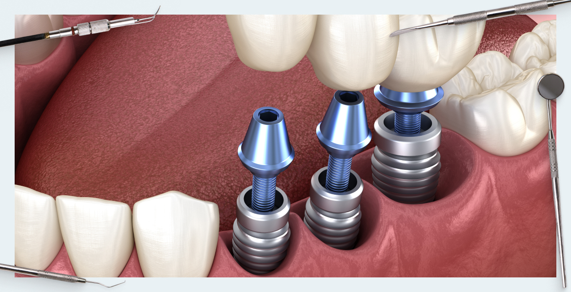 Errors and complications during prosthetics on implants. How to prevent and correct them