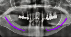 Orthopantomogram of the patient