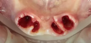 Condition of soft tissues immediately after tooth extraction