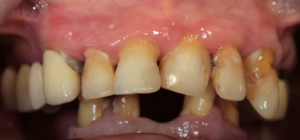 Condition of the remaining teeth on the lower jaw