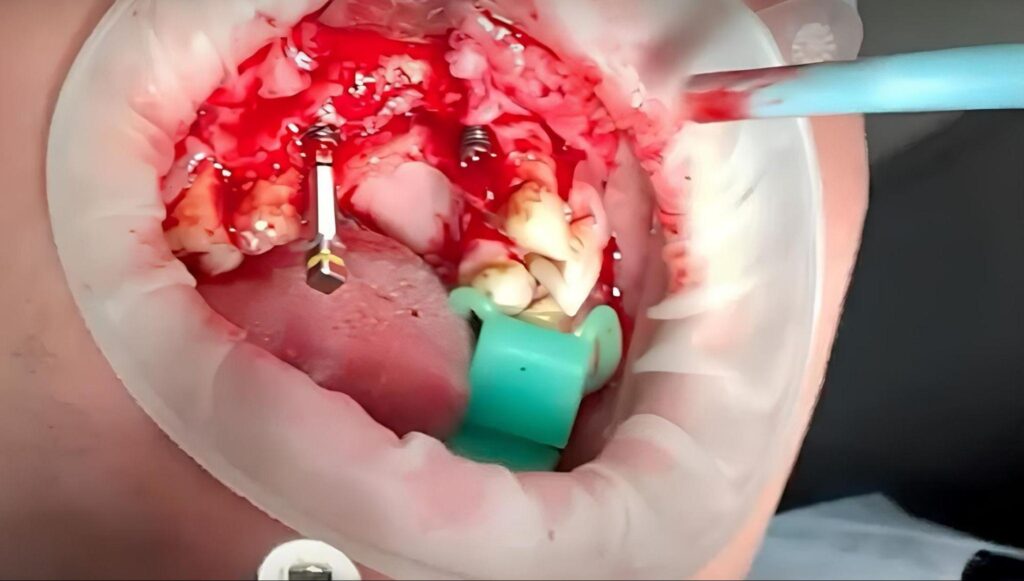 Implant removal process