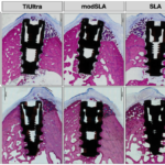 Osseointegration of Anodized vs. Sandblasted Implant Surfaces in a Guided Bone Regeneration Acute Dehiscence-Type Defect: An In Vivo Experimental Mandibular Minipig Model