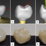 Pull-Off Forces on Implant-Supported Single Restorations by Sticky Food: An In Vitro Study