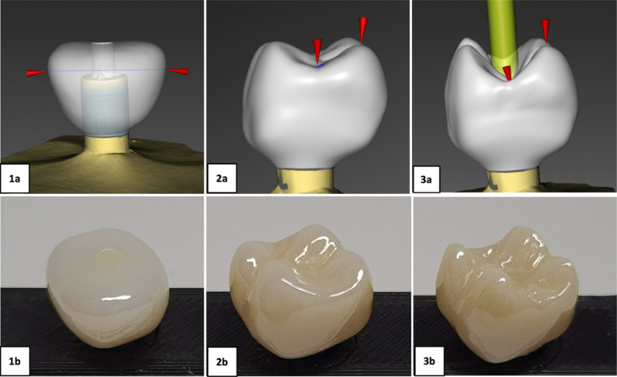 Pull-Off Forces on Implant-Supported Single Restorations by Sticky Food: An In Vitro Study