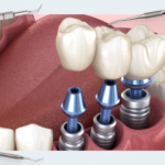 Dental Implant Meta-Analyses 2024: From Navigation to Long-Term Survival