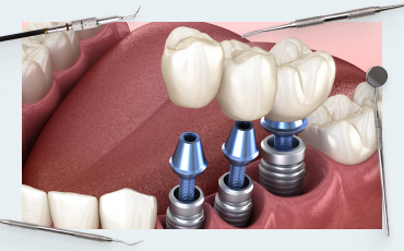 Dental Implant Meta-Analyses 2024: From Navigation to Long-Term Survival