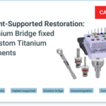 Cement retained Zironium Bridge with Custom Titanium Abutments. Implant-Supported Restoration. 67 Year Old Male with an Uncomplicated Medical History