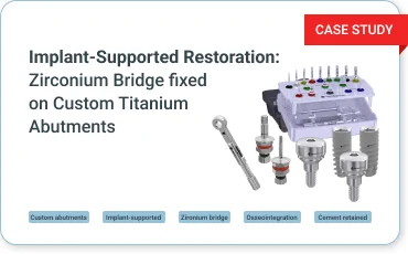 Cement retained Zironium Bridge with Custom Titanium Abutments. Implant-Supported Restoration. 67 Year Old Male with an Uncomplicated Medical History