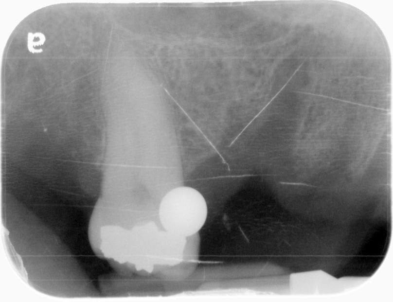 Intraoperative x-ray