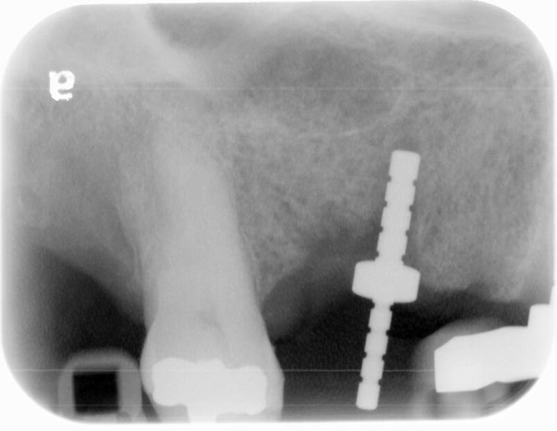 Post-operative x-ray