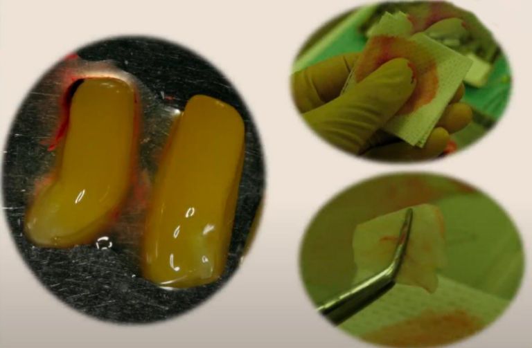 Dental Sinus Lift Surgery: Open & Closed Methods [Complete Guide]