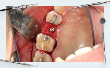 Features of a Sinus Lift Surgery. Part 1