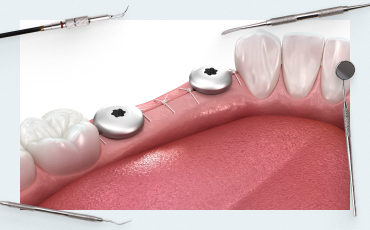 Alveolar Ridge Split Techniques: Simultaneous Implant Placement (Part 2)