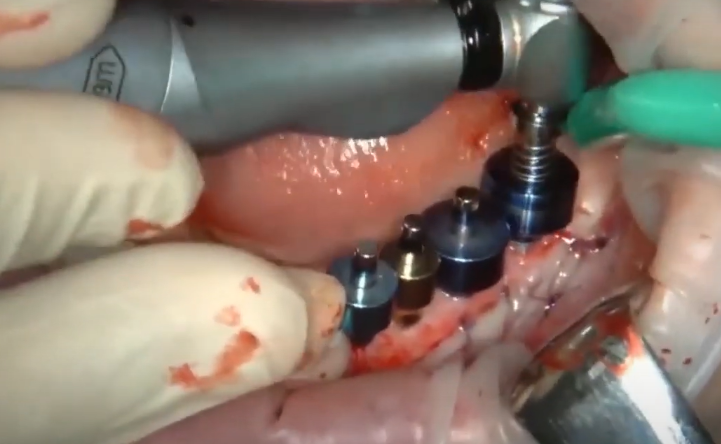 Drilling A Hole For The Last Molar (Tooth 7) Using A Surgical Guide Youtube / Dr. Kamil Khabiev / Dental Guru Academy Drilling a hole for the last molar (tooth 7) using a surgical guide youtube / dr. Kamil khabiev / dental guru academy