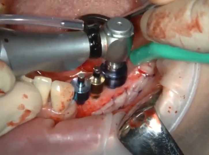 Drilling A Hole To Place An Implant At Position 6: The Restrictive Ring Here Has A Large Diameter (9Mm) Youtube / Dr. Kamil Khabiev / Dental Guru Academy Drilling a hole to place an implant at position 6: the restrictive ring here has a large diameter (9mm) youtube / dr. Kamil khabiev / dental guru academy