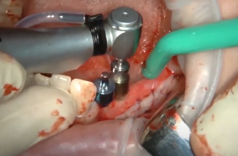 Drilling Through The Second Hole At Position 5 - This Is Where The Implant Will Be Placed Youtube / Dr. Kamil Khabiev / Dental Guru Academy Drilling through the second hole at position 5 - this is where the implant will be placed youtube / dr. Kamil khabiev / dental guru academy