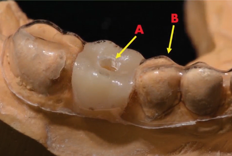 Making A Celluloid Surgical Guide Using A Wax-Up Crown Youtube / Dr. Kamil Khabiev / Dental Guru Academy Making a celluloid surgical guide using a wax-up crown youtube / dr. Kamil khabiev / dental guru academy