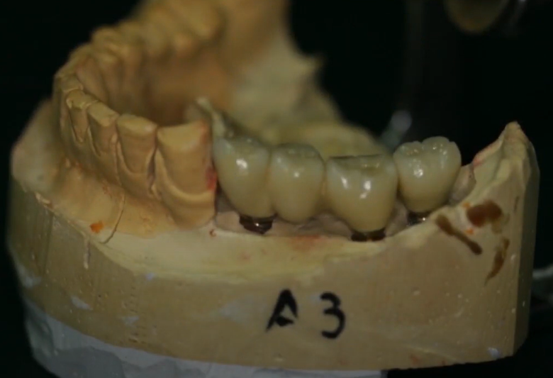 Inaccurate Positioning Of The Implant In The Area Of Tooth #34 Led To The Emergence Of A Cantilever Youtube / Dr. Kamil Khabiev / Dental Guru Academy Inaccurate positioning of the implant in the area of tooth #34 led to the emergence of a cantilever youtube / dr. Kamil khabiev / dental guru academy