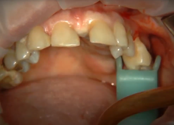 Initial Situation: Congenital Absence Of Lateral Incisors, Wide Diastema, And Anterior Incisors At An Incorrect Angle Youtube/Dr. Kamil Khabiev / Dental Guru Academy Initial situation: congenital absence of lateral incisors, wide diastema, and anterior incisors at an incorrect angle youtube/dr. Kamil khabiev / dental guru academy