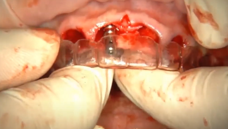 Placement Of Implants Using A Celluloid Guide: Each Step Is Followed By Checking The Correct Position Of The Implant Youtube / Dr. Kamil Khabiev / Dental Guru Academy Placement of implants using a celluloid guide: each step is followed by checking the correct position of the implant youtube / dr. Kamil khabiev / dental guru academy