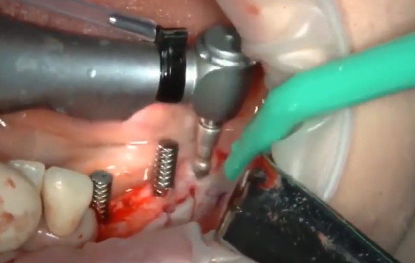 Placement Of Three Implants At Positions 4, 6 And 7 Youtube / Dr. Kamil Khabiev / Dental Guru Academy Placement of three implants at positions 4, 6 and 7 youtube / dr. Kamil khabiev / dental guru academy