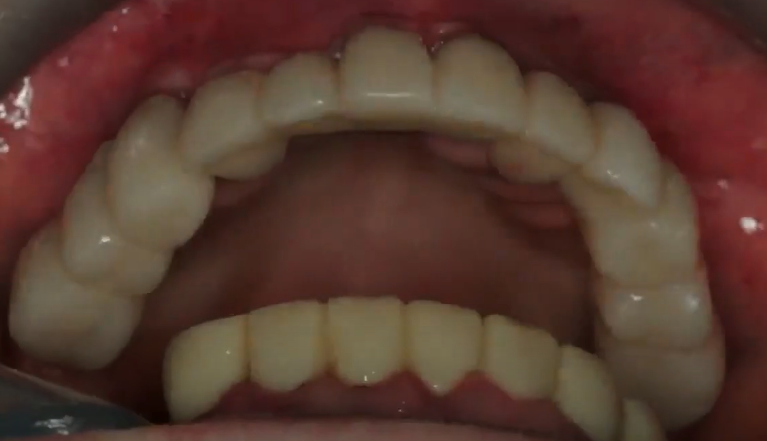 Temporary Restoration On Non-Optimally Placed Implants Youtube / Dr. Kamil Khabiev / Dental Guru Academy Temporary restoration on non-optimally placed implants youtube / dr. Kamil khabiev / dental guru academy