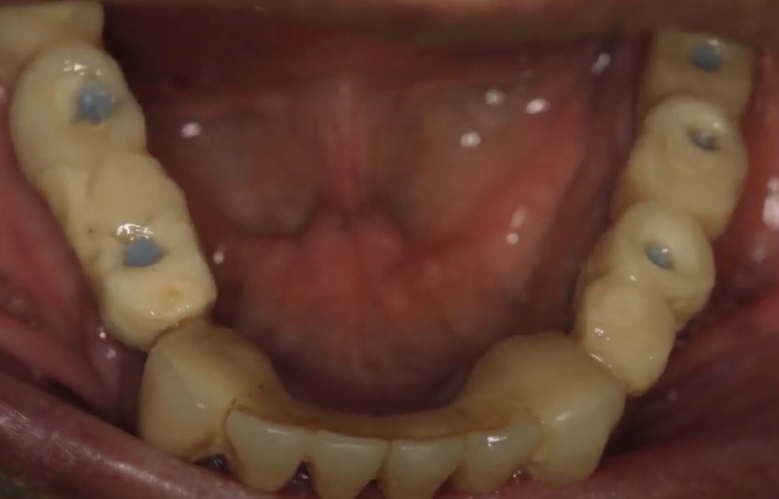 Temporary Structure Which Served As A Guide With Screw Shafts Closed With A-Silicone - After 3 Months Of Use Youtube/Dr. Kamil Khabiev / Dental Guru Academy Temporary structure which served as a guide with screw shafts closed with a-silicone - after 3 months of use youtube/dr. Kamil khabiev / dental guru academy