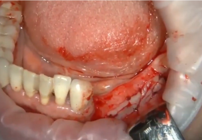 The Apically Displaced Flap Is Fixed With Sutures At The Site Of Formation Of The New Attached Gum Youtube / Dr. Kamil Khabiev / Dental Guru Academy The apically displaced flap is fixed with sutures at the site of formation of the new attached gum youtube / dr. Kamil khabiev / dental guru academy
