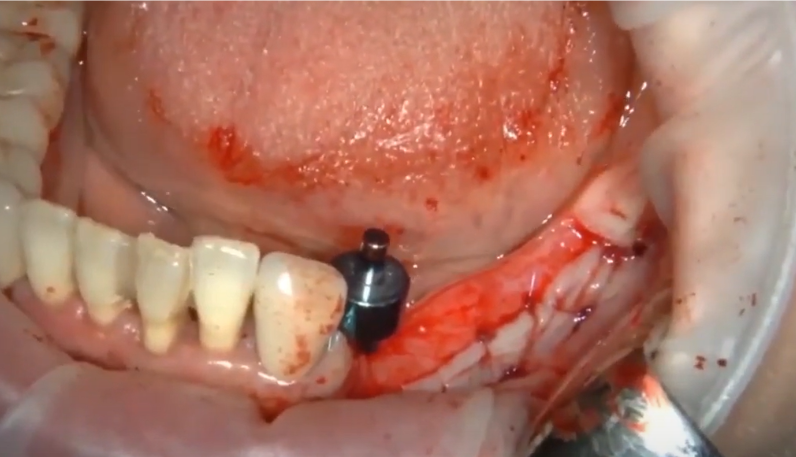The First Pin Is Placed And Serves As A Guide For The Next Holes Youtube/Dr. Kamil Khabiev / Dental Guru Academy The first pin is placed and serves as a guide for the next holes youtube/dr. Kamil khabiev / dental guru academy