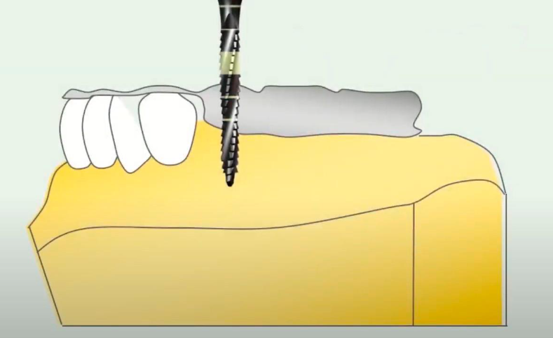 The Principle Of Using A Surgical Guide To Prepare A Site For An Implant Youtube / Dr. Kamil Khabiev / Dental Guru Academy The principle of using a surgical guide to prepare a site for an implant youtube / dr. Kamil khabiev / dental guru academy