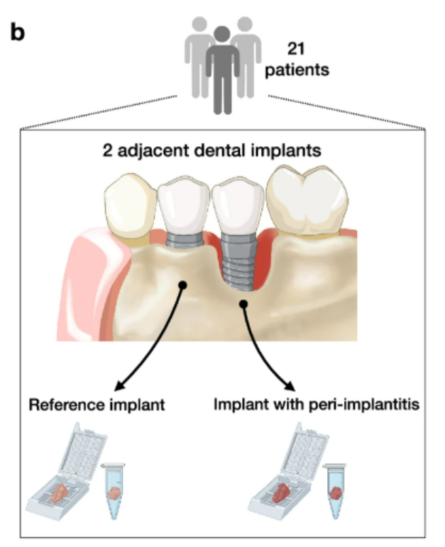 Titanium Micro-Particles Around Dental Implants: Implications for Oral Health and Implant Longevity