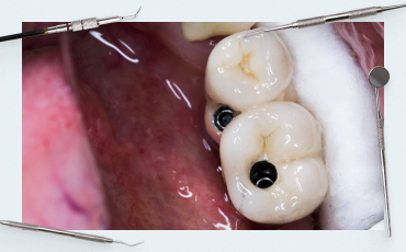 Using Surgical Guides During Implantation