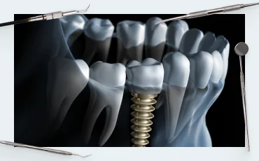 How to evaluate primary implant stability: innovations and prospects