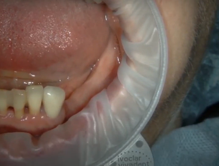 Initial Situation: Complete Absence Of Teeth In The Lateral Region + Significant Atrophy Of The Attached Gum Youtube / Dr. Kamil Khabiev / Dental Guru Academy Initial situation: complete absence of teeth in the lateral region + significant atrophy of the attached gum youtube / dr. Kamil khabiev / dental guru academy