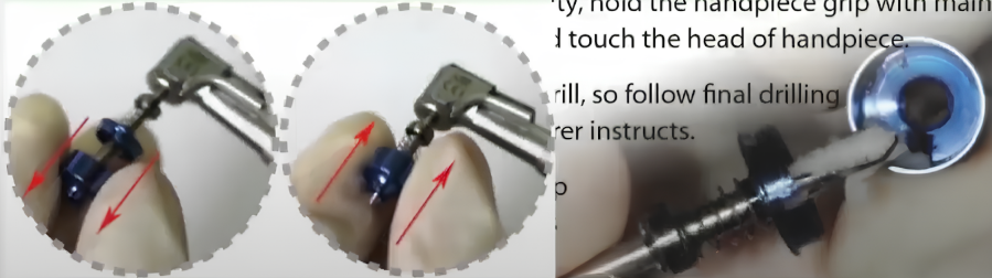 Each Drill With A Hollow Ring From A Set Is A Drive (Trap) For Collecting Bone Chips From The Patient Themselves Youtube / Dr. Kamil Khabiev / Dental Guru Academy Each drill with a hollow ring from a set is a drive (trap) for collecting bone chips from the patient themselves youtube / dr. Kamil khabiev / dental guru academy