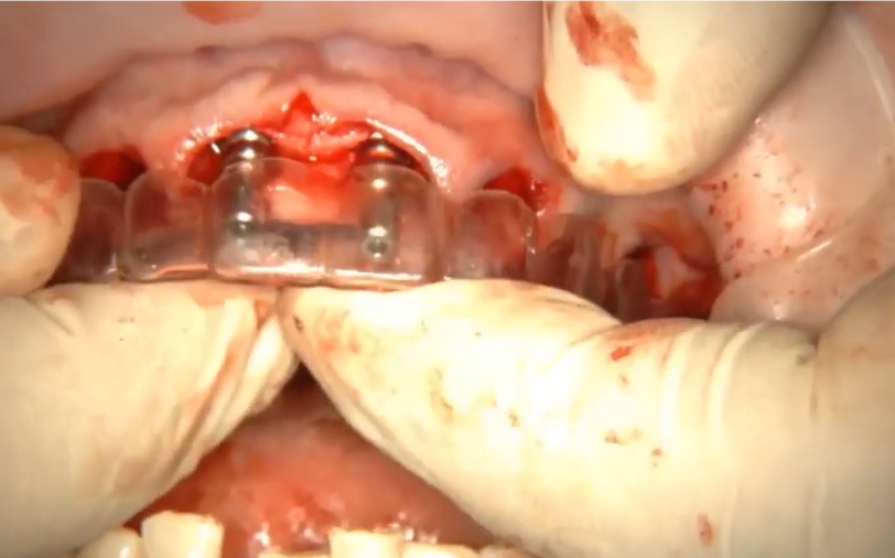 Placing The Second Implant And Checking Its Position Relative To The First And Future Prosthesis Using A Surgical Guide Youtube / Dr. Kamil Khabiev / Dental Guru Academy Placing the second implant and checking its position relative to the first and future prosthesis using a surgical guide youtube / dr. Kamil khabiev / dental guru academy
