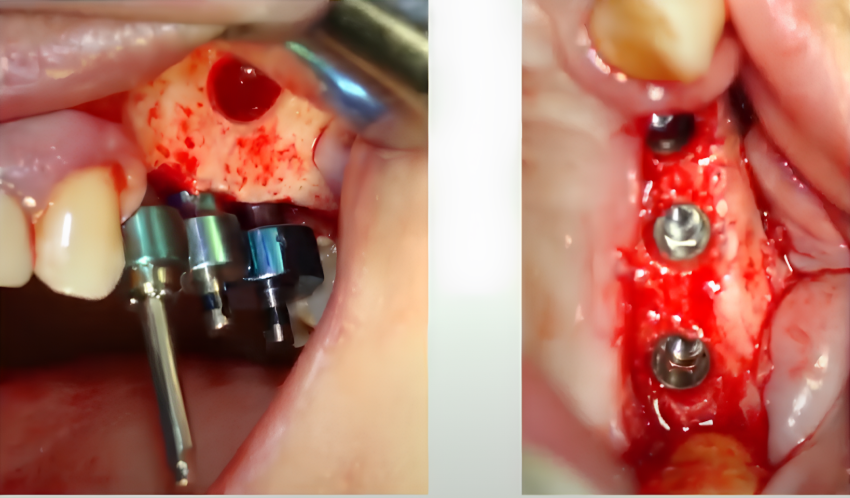 Using A Surgical Guide (Left) - Implants In Optimal Prosthetic Position (Right) Youtube / Dr. Kamil Khabiev / Dental Guru Academy Using a surgical guide (left) - implants in optimal prosthetic position (right) youtube / dr. Kamil khabiev / dental guru academy