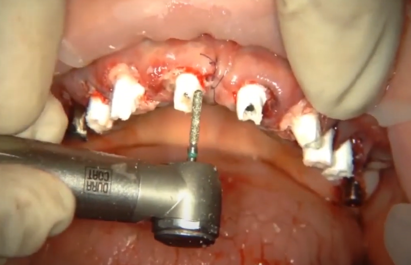 Checking The Volume Of Plastic Abutments Before Attaching The Temporary Prosthesis Using A Celluloid Guide And Modifying The Abutments Youtube/Dr. Kamil Khabiev / Dental Guru Academy Checking the volume of plastic abutments before attaching the temporary prosthesis using a celluloid guide and modifying the abutments youtube/dr. Kamil khabiev / dental guru academy
