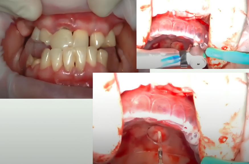 The Initial Situation Is Prognathism Of The Lower Jaw And Preparation Of The Site For Implants Using A Simple Celluloid Guide Youtube / Dr. Kamil Khabiev / Dental Guru Academy The initial situation is prognathism of the lower jaw and preparation of the site for implants using a simple celluloid guide youtube / dr. Kamil khabiev / dental guru academy