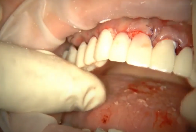 Placement Of A Temporary Prosthesis On Plastic Abutments Youtube/Dr. Kamil Khabiev / Dental Guru Academy Placement of a temporary prosthesis on plastic abutments youtube/dr. Kamil khabiev / dental guru academy