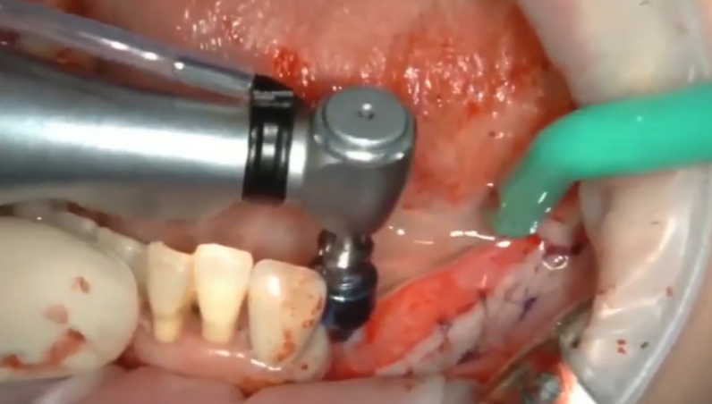 The First Pass With A Drill With A Restrictive Ring Next To The Remaining Tooth; At The First Stage, The Hole Is Needed To Install A Pin With A Restrictor Into It And Be Guided By It When Drilling The Next Holes Youtube / Dr. Kamil Khabiev / Dental Guru Academy The first pass with a drill with a restrictive ring next to the remaining tooth; at the first stage, the hole is needed to install a pin with a restrictor into it and be guided by it when drilling the next holes youtube / dr. Kamil khabiev / dental guru academy