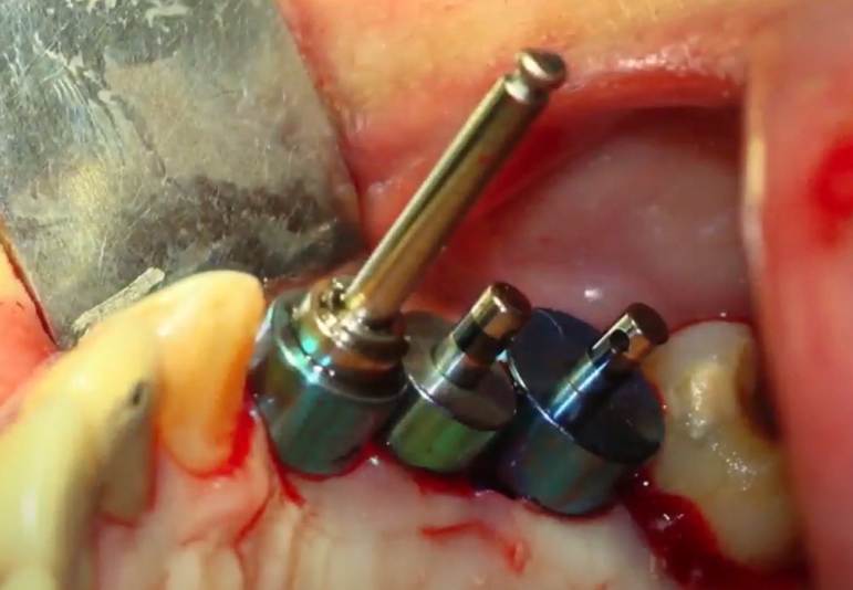 An Example Of The Use Of A Surgical Guide From A Set For The Treatment Of A Local Defect (The Absence Of Three Teeth) Youtube / Dr. Kamil Khabiev / Dental Guru Academy An example of the use of a surgical guide from a set for the treatment of a local defect (the absence of three teeth) youtube / dr. Kamil khabiev / dental guru academy