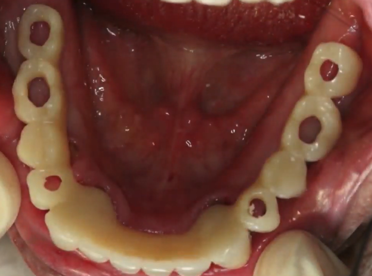 A Temporary Prosthesis Can Serve As A Surgical Guide - Saving The Patient Time And Money Youtube / Dr. Kamil Khabiev / Dental Guru Academy A temporary prosthesis can serve as a surgical guide - saving the patient time and money youtube / dr. Kamil khabiev / dental guru academy