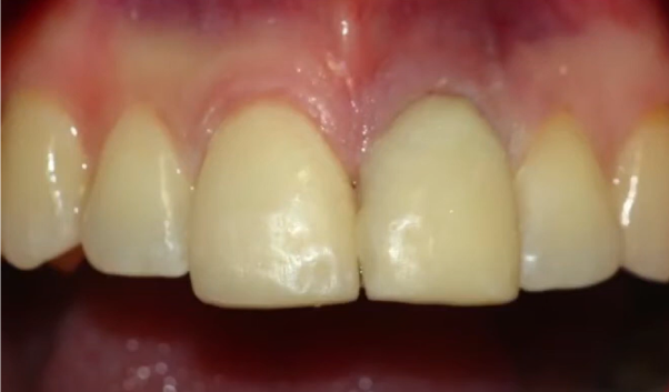 A Temporary Crown For Immediate Implantation Helps Maintain The Buccal Gingival Contour And Volume, Preventing Tissue Blanching Or Recession Youtube / Dr. Kamil Khabiev / Dental Guru Academy A temporary crown for immediate implantation helps maintain the buccal gingival contour and volume, preventing tissue blanching or recession youtube / dr. Kamil khabiev / dental guru academy